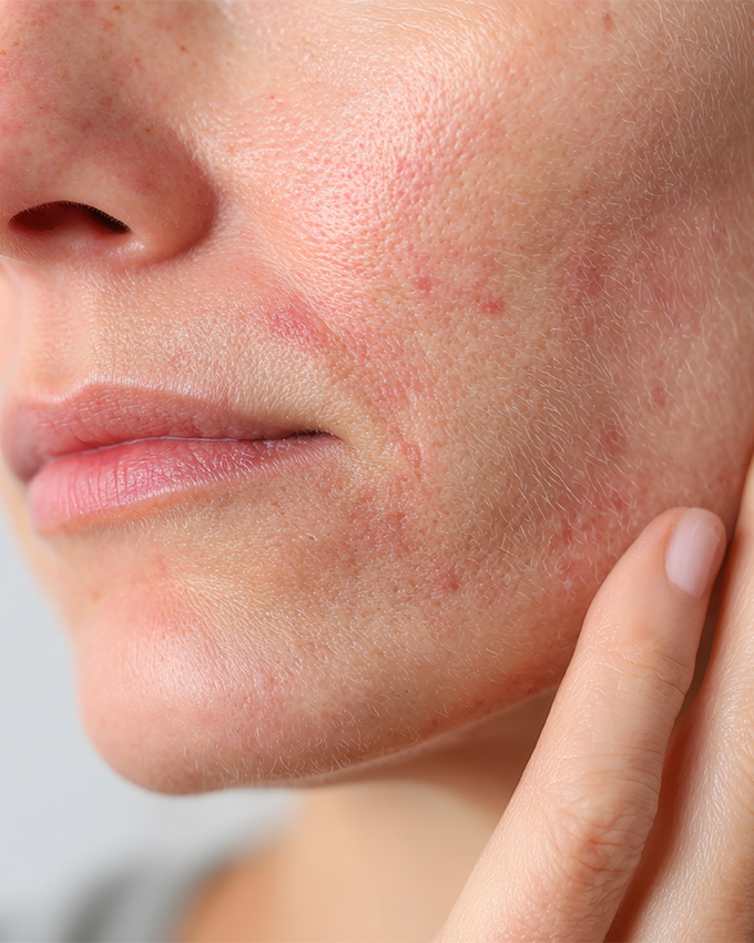 Blemished skin during menopause