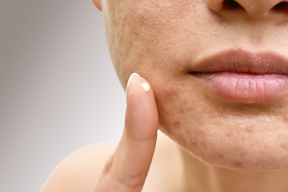 Retinol for acne scars