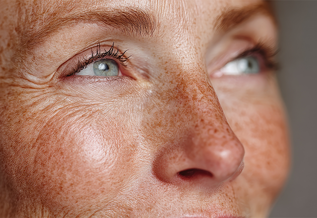 Pigmentation spots during menopause