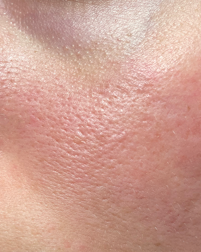 Large pores during menopause